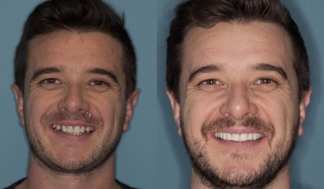 Martin — Invisalign