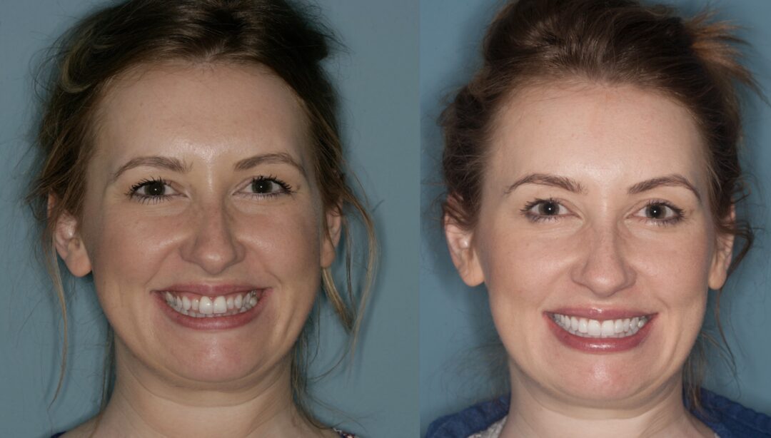 Sam — Invisalign