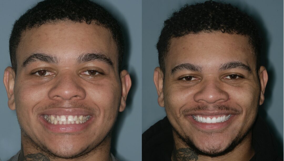 Chris — Invisalign